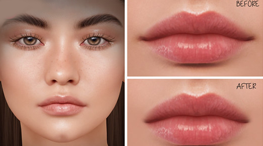 Lip Flip Before & After: Common FAQs You Need To Know About The Treatment
